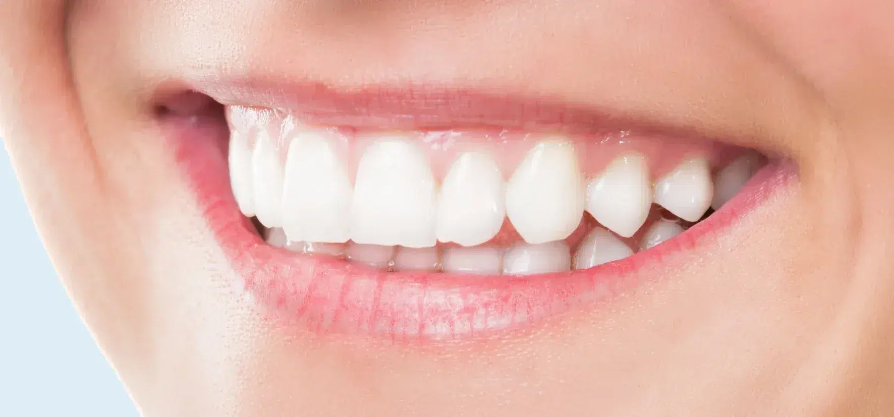 Bleaching – ganz einfach schöne weisse Zähne (Deutsch)